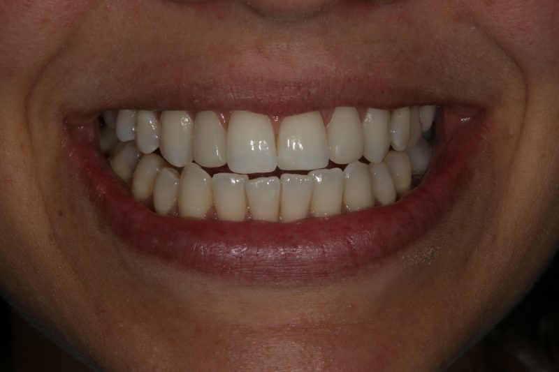 Smile makeover after