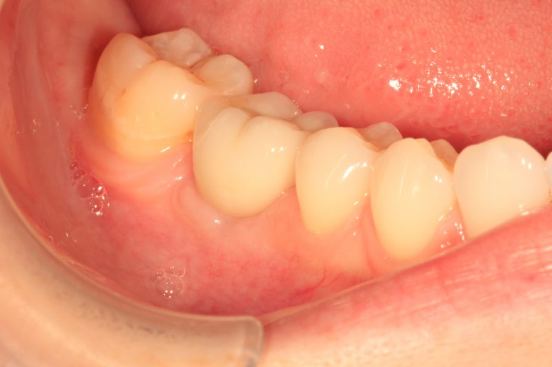 After Dental Implants