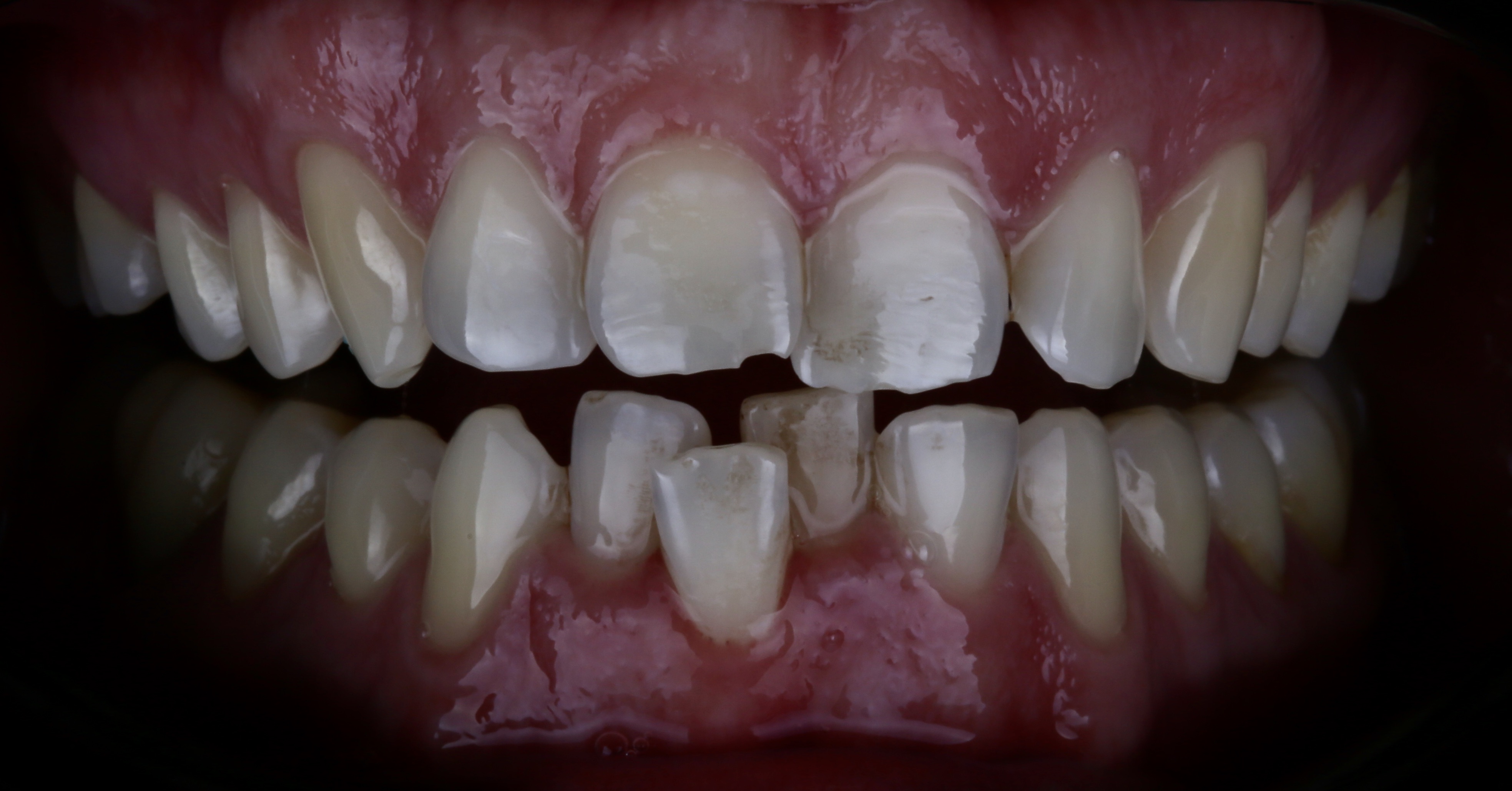 Crowded and overlapped front teeth