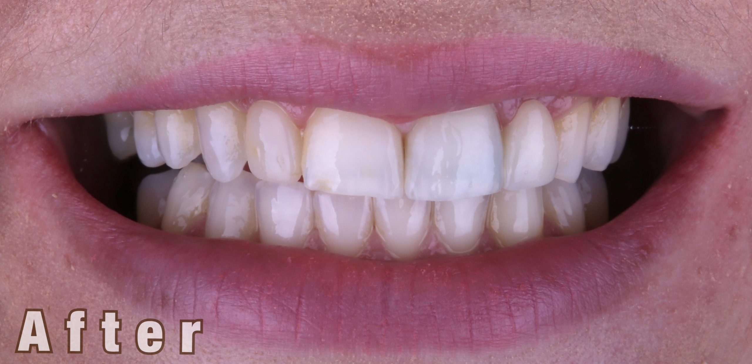 After Invisalign , whitening and Bonding