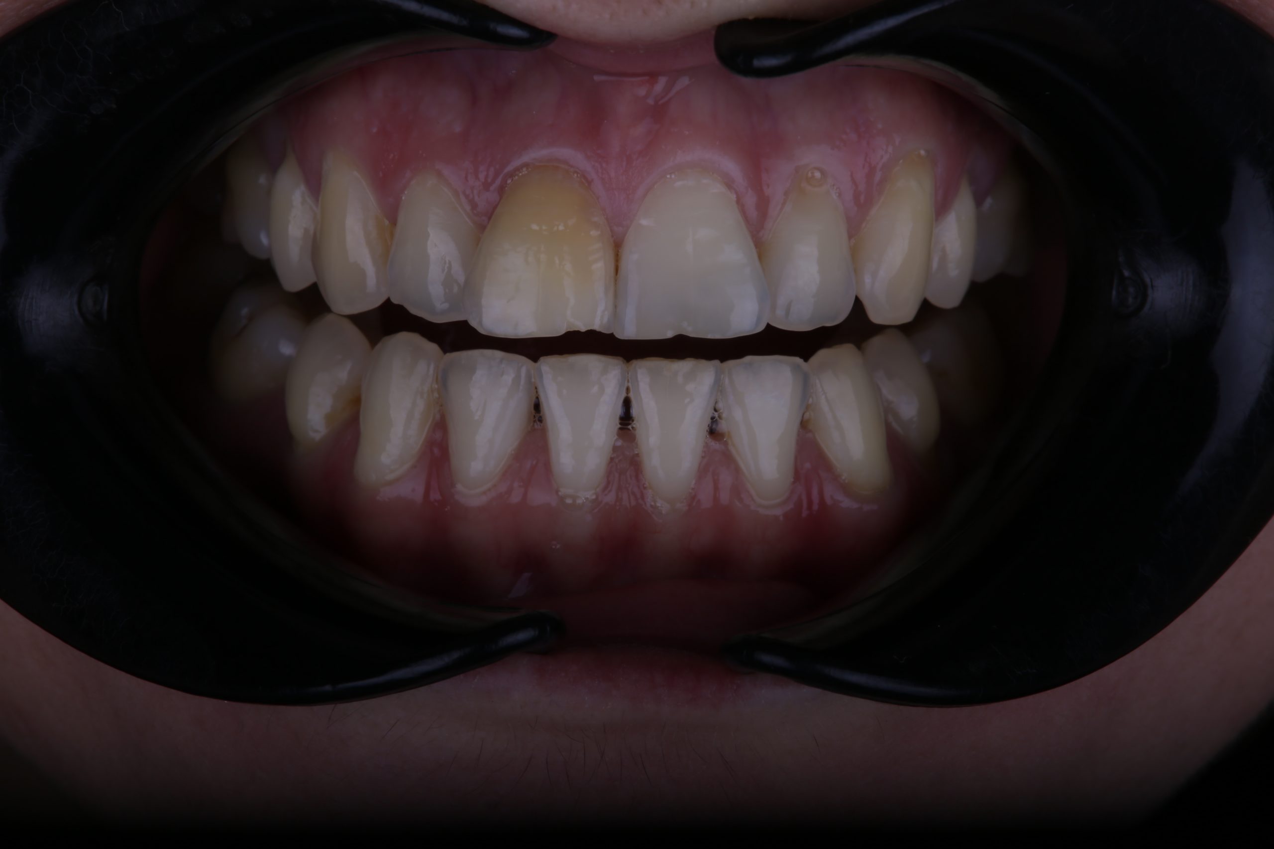 Upper front discolored tooth