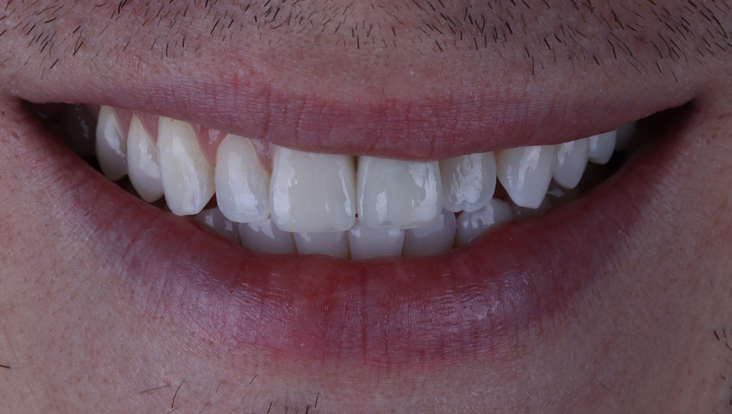 Teeth whitening followed by ICON treatment