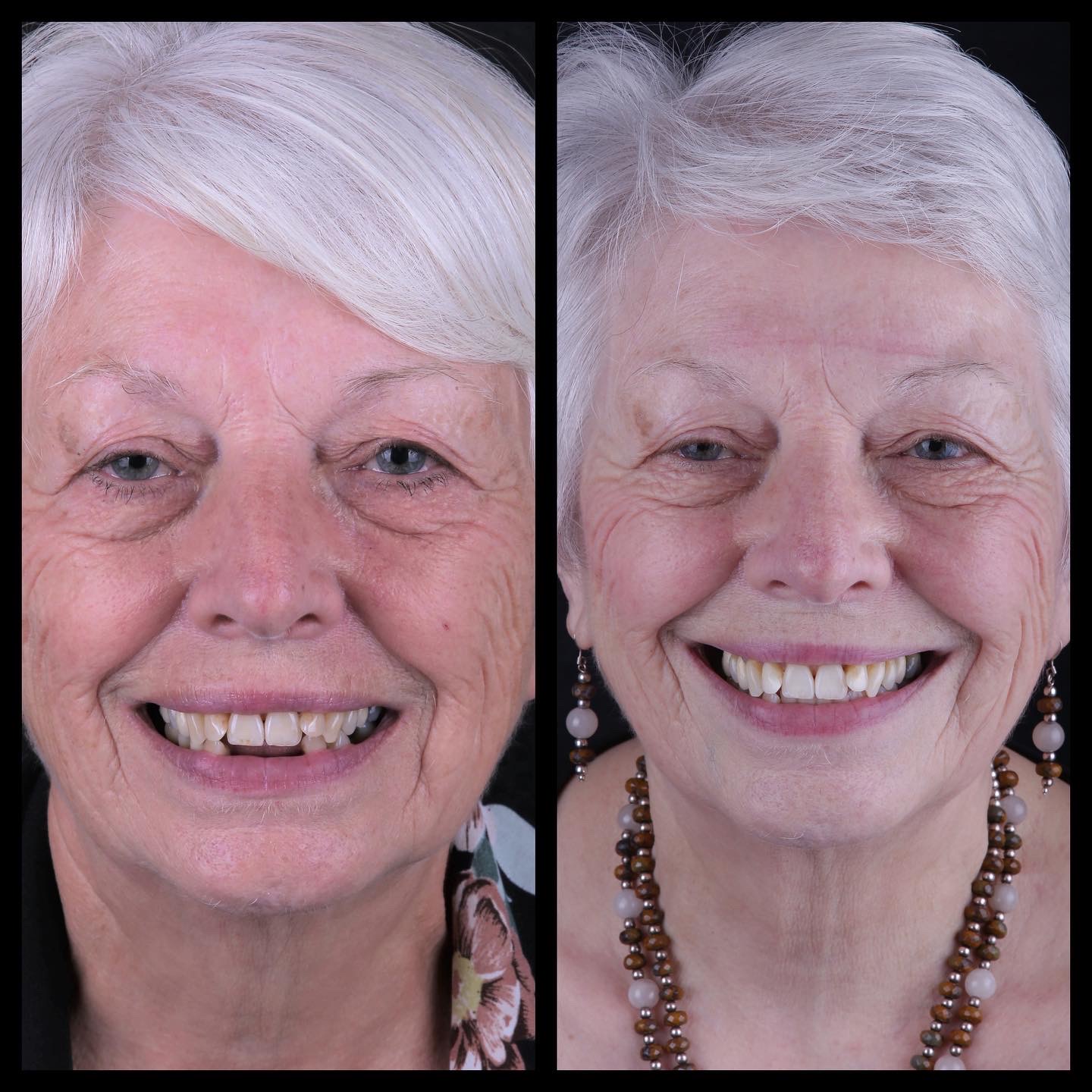Teeth replacement with DENTAL IMPLANTS Greenwich Dental Health