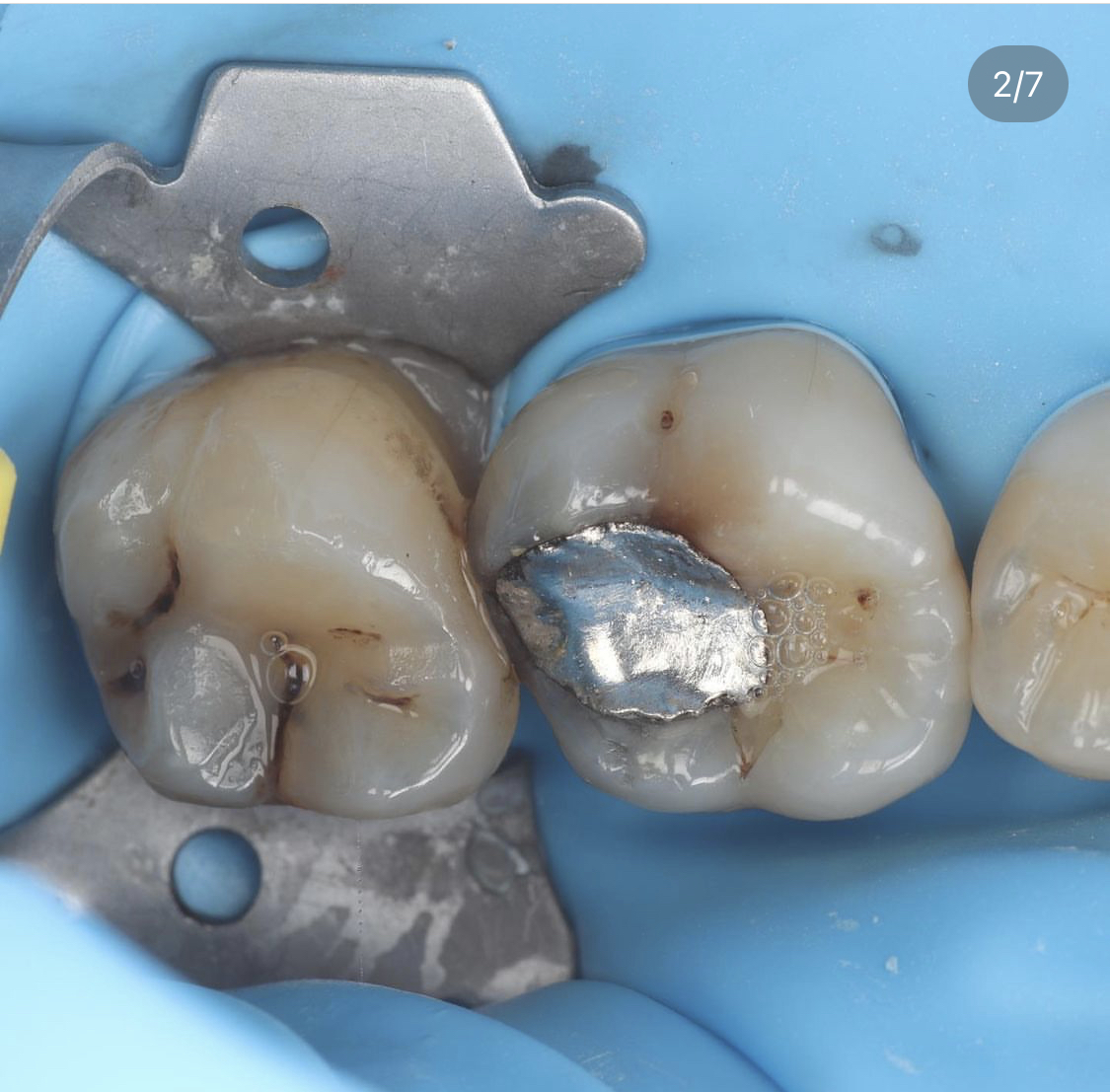 An old silver ( amalgam ) fillings