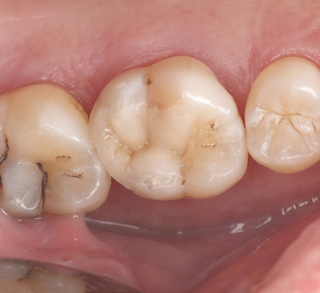A well contoured composite filling