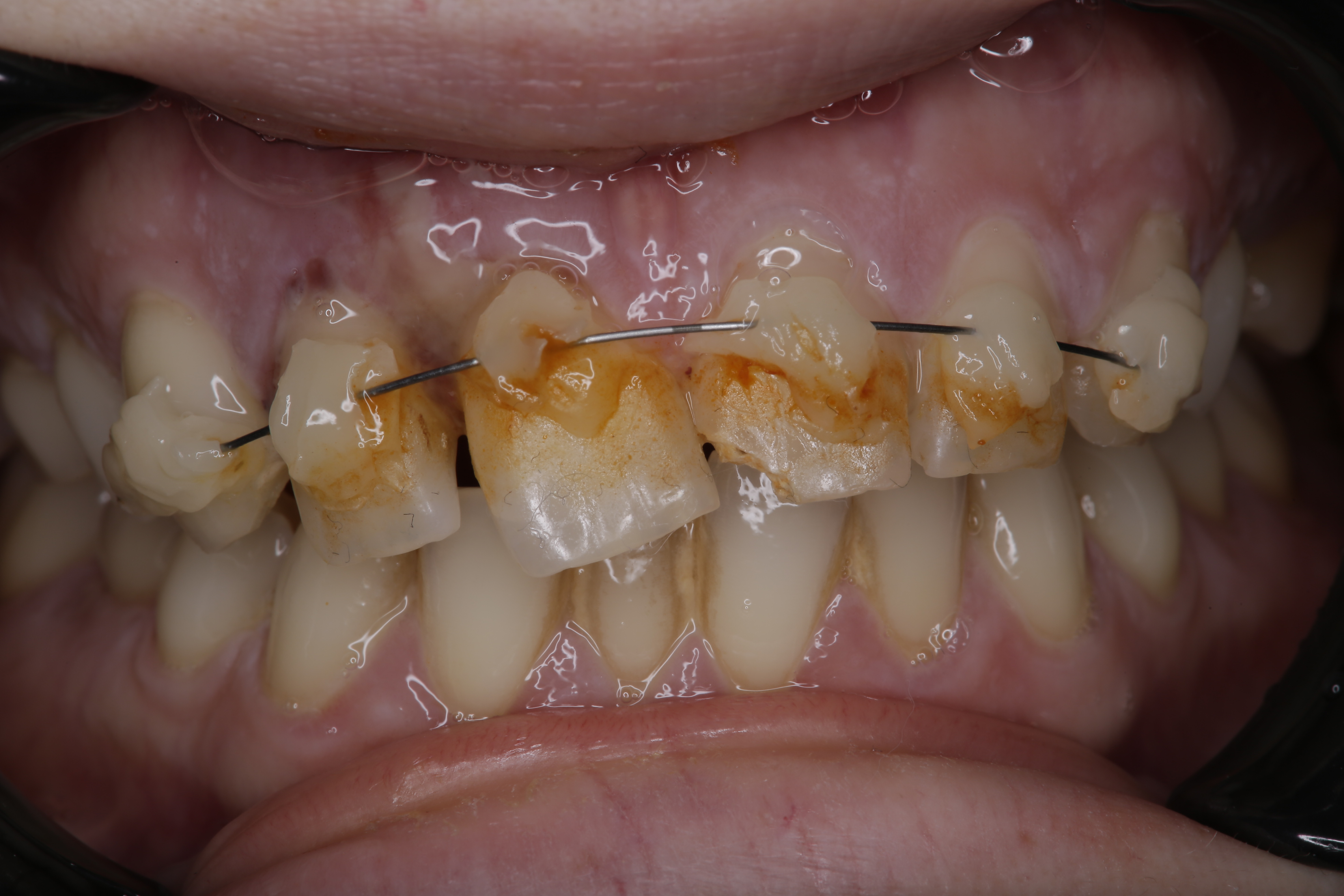 Damaged front tooth